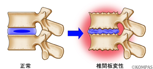 図１．左：正常椎間板、右：変性椎間板