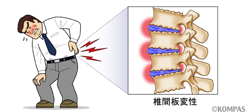 図２．椎間板変性は腰痛の原因の一つ