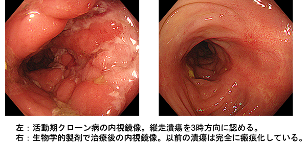 図１．治療前後の大腸内視鏡像