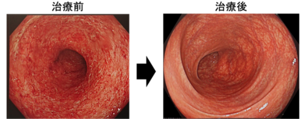図１．活動期（左）と寛解期（右）の大腸内視鏡所見