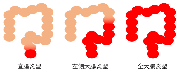 図２．潰瘍性大腸炎の病変範囲に基づく分類（赤色：炎症部）