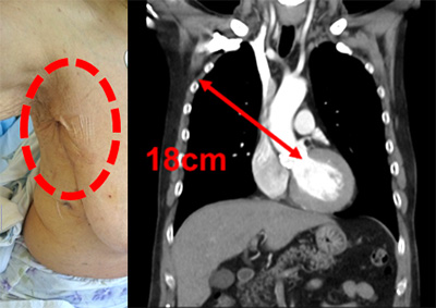 図３．右腋窩小切開アプローチによる大動脈弁置換術の症例