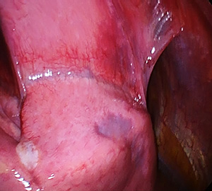 図４．再発性気胸の胸腔内所見