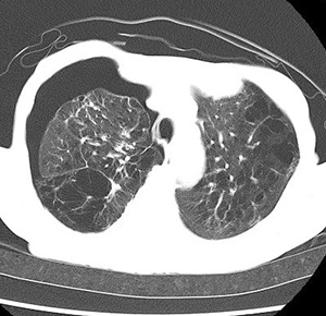 図５．肺気腫治療中の続発性気胸症例
