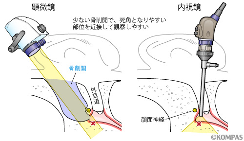 図３．内視鏡を用いるメリット２