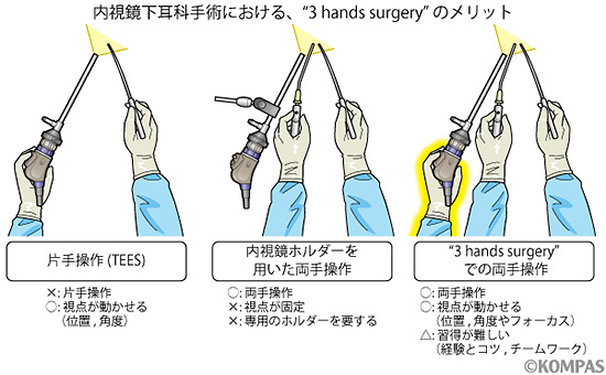 内視鏡下耳科手術（TEES） ―耳鼻咽喉科―｜KOMPAS