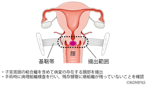 広汎性子宮頸部摘出術後妊娠における残存頸管長と早産リスクの関連は 