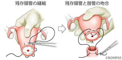 図４．広汎性子宮頸部摘出術における頸管縫縮および腟管との吻合