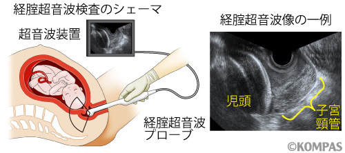 図５．経腟超音波による子宮頸管長の測定