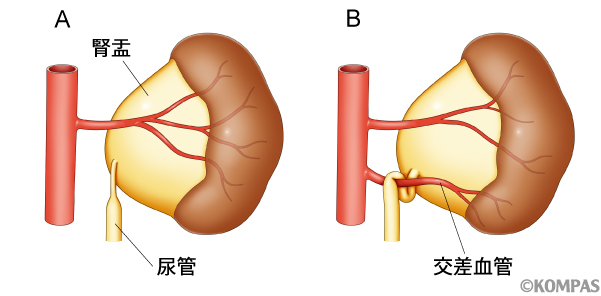 図1．水腎症