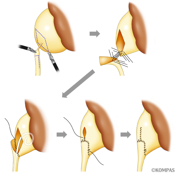 図2．腎盂形成術