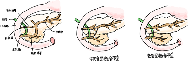 図1．膵管癒合不全