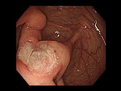 図１．典型的な腸管ベーチェット病の回盲部の深掘れ潰瘍