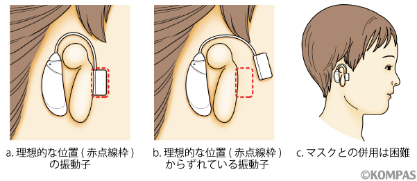 図１．右小耳症に対して軟骨伝導補聴器を装用している状態