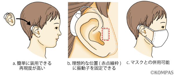 図４．右小耳症に対してAPiCHAを装用している状態
