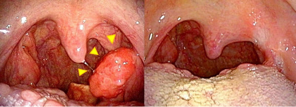 図１．中咽頭がんTOVS症例