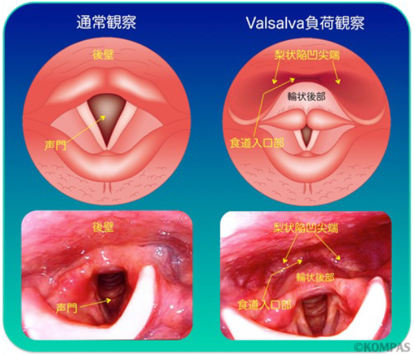 図１．経鼻内視鏡による下咽頭粘膜観察（Valsalva負荷法）