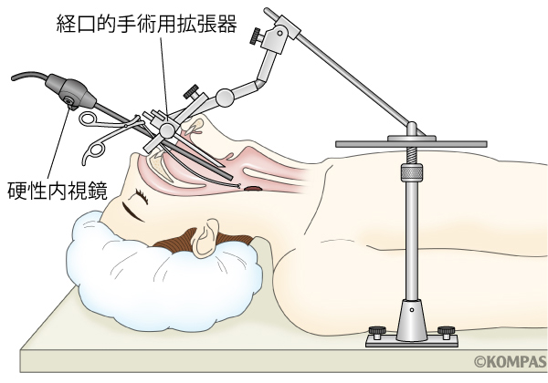 図４．経口的手術用拡張器+硬性内視鏡によるTOVS（経口腔的ビデオ喉頭鏡下手術）