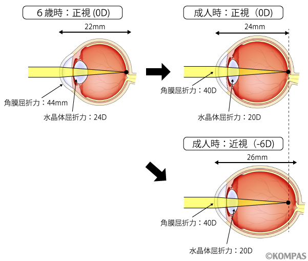 図１．眼軸長伸長と近視進行
