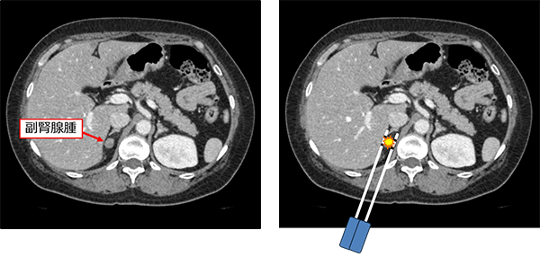 図２．左：右副腎腺腫　右：焼灼のイメージ