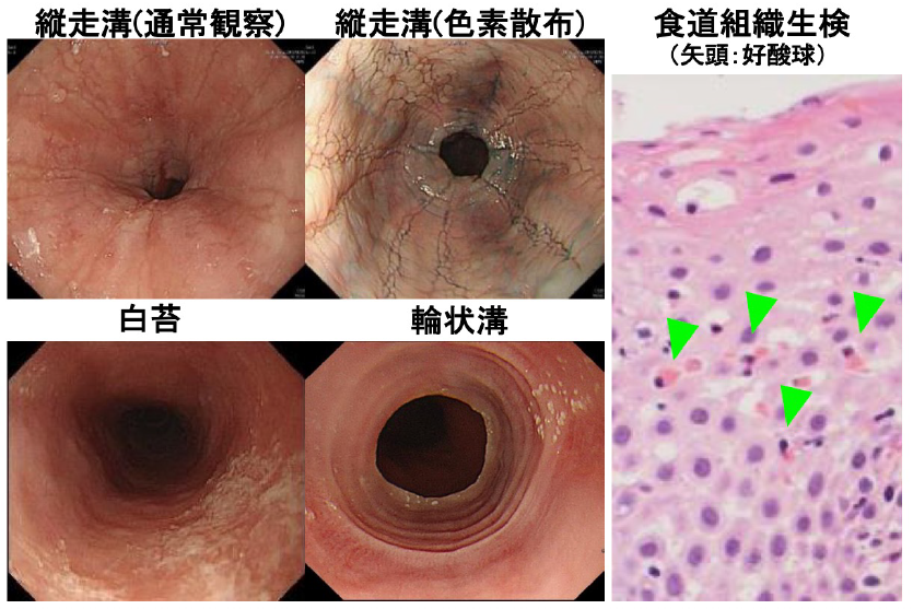 図１．好酸球性食道炎に特徴的な内視鏡所見と病理所見　