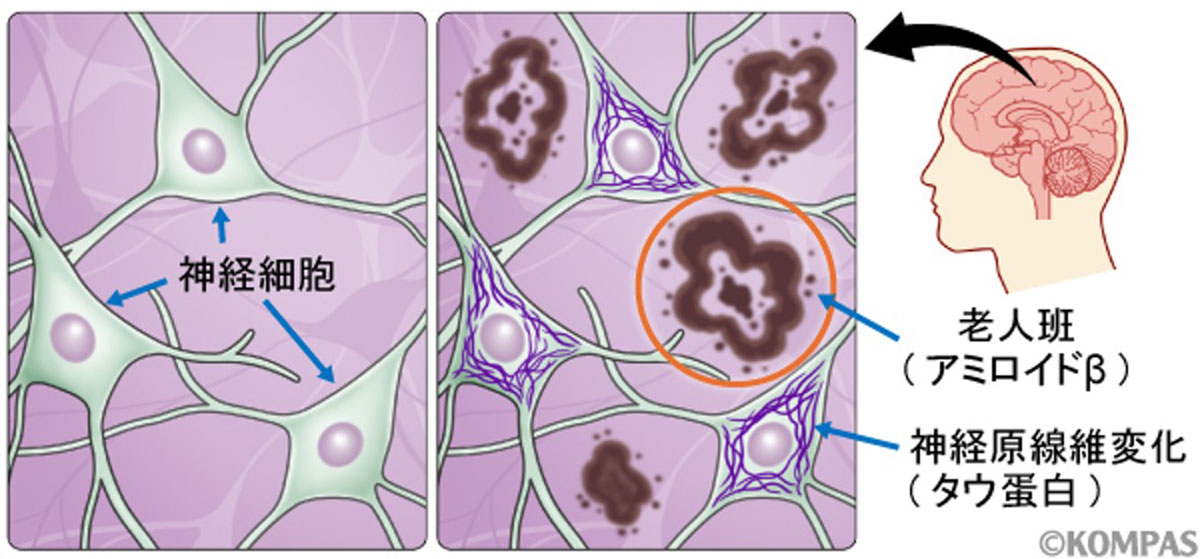 図１．アルツハイマー病の蓄積タンパク