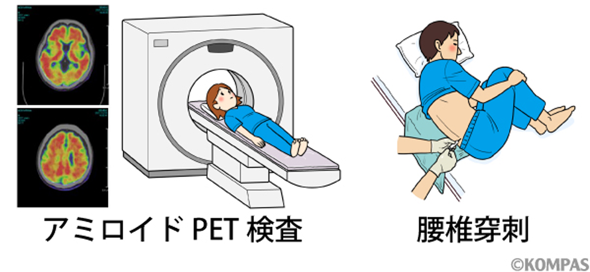 図２．アルツハイマー病の新しい検査