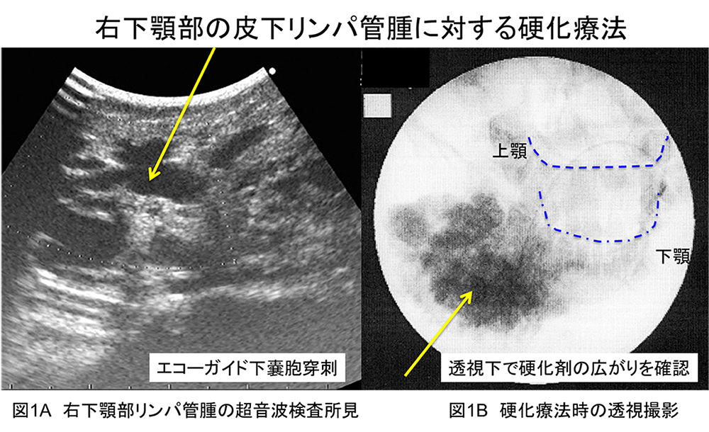 右下頸部の皮下リンパ管腫に対する硬化療法