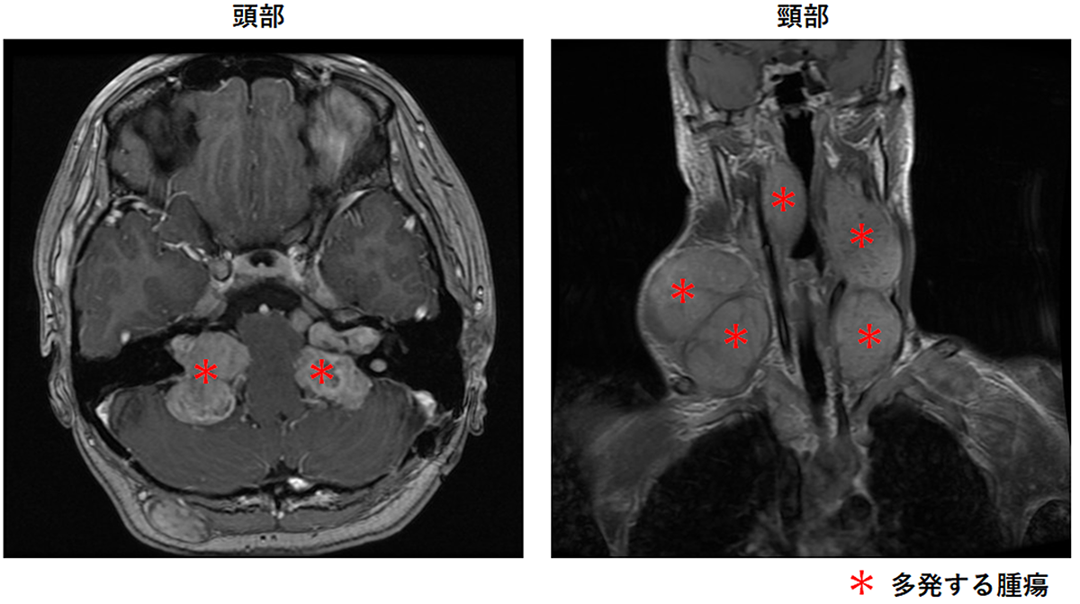 図１．NF2患者さんに多発する腫瘍